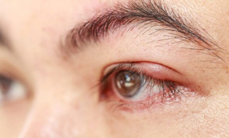 8 asal-mula mata bintitan kemudian cara mengatasinya secara alami